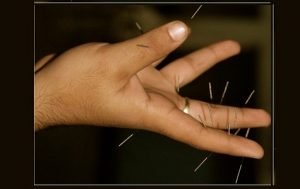 Acupuncture-Therapists